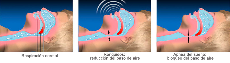 Apnea Del Sueño - Aguilar Dental Salut