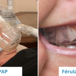 Apnea del Sueño, ventajas de la Férula-DAM vs CPAP Clinica Aguilar