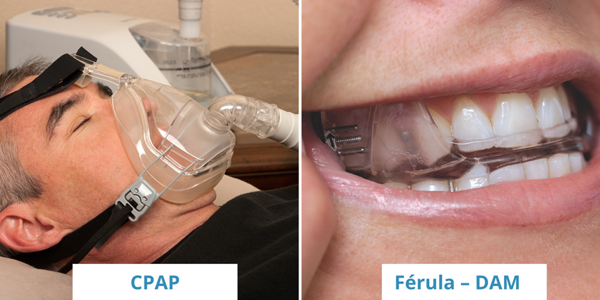 Apnea del sueño aparatos dentales y alternativas a CPAP